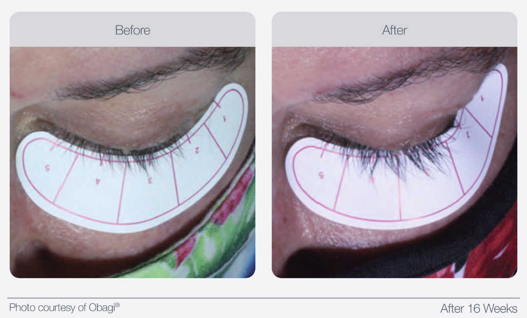 improve eyelashes before and after